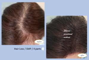 Hair loss SMP