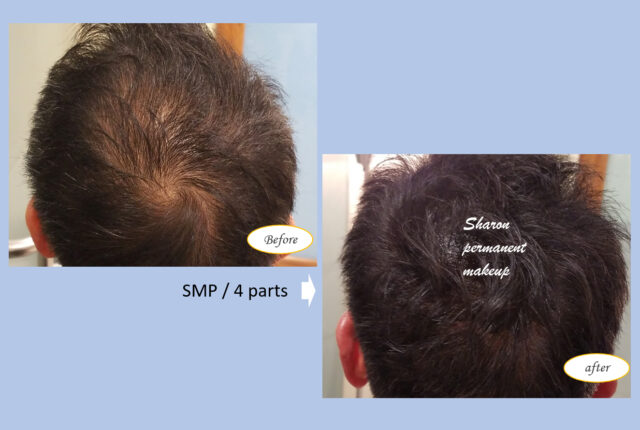 Hair loss | SMP
