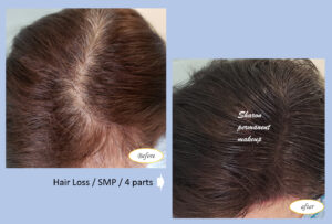 Hair loss | SMP