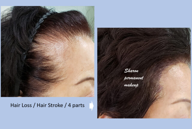 Hair loss | Hair Stroke