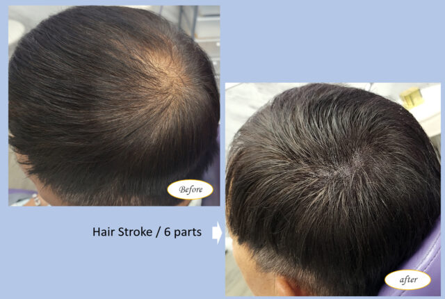 Hair loss | Hair Stroke